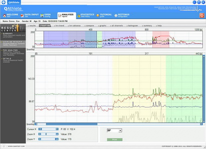 Exercise ECG Analysis